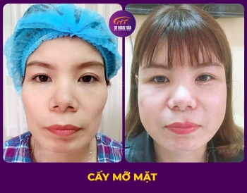CẤY MỠ